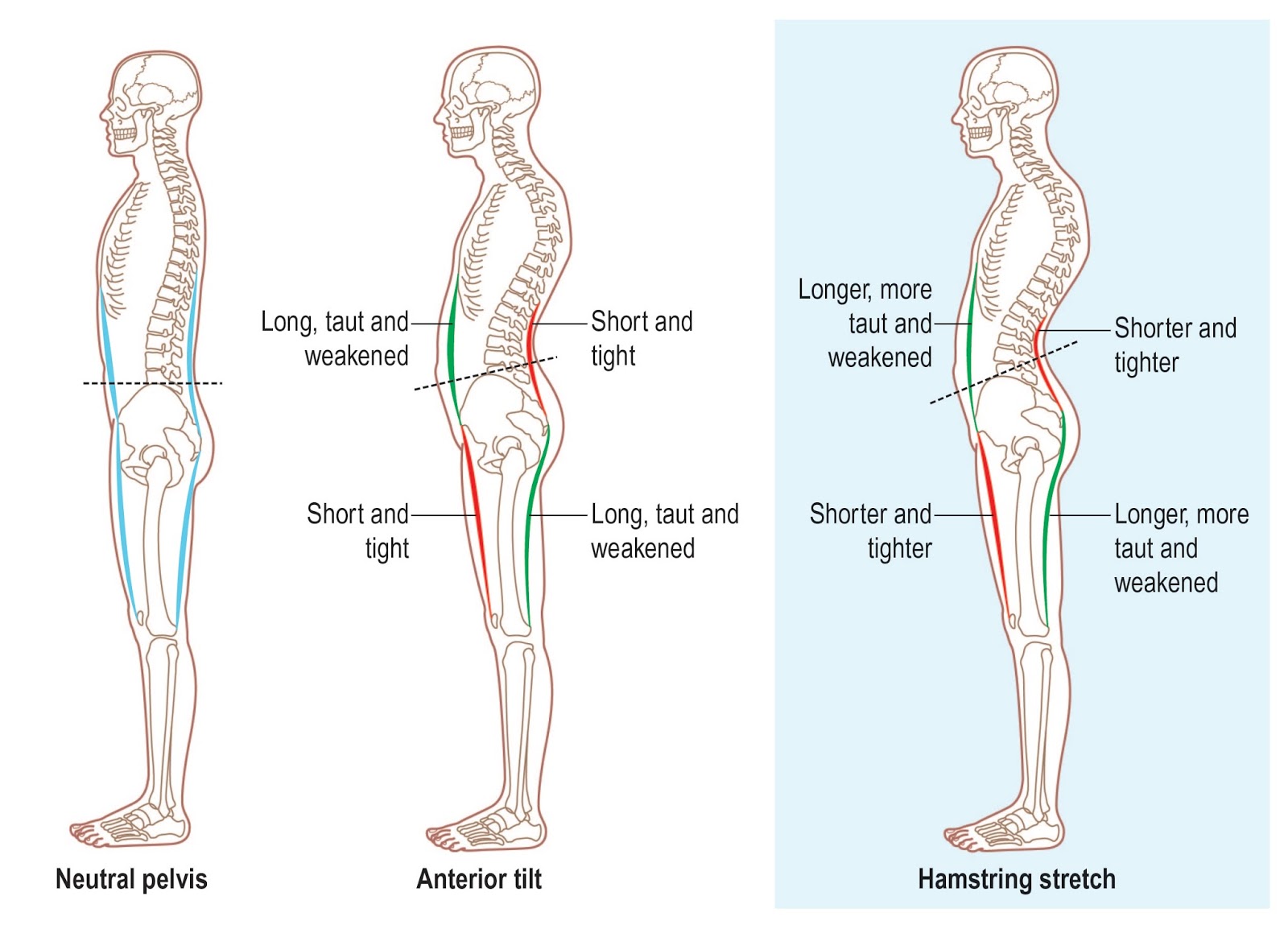 anterior-pelvic-tilt