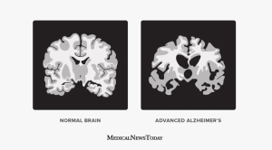 Largest Brain Study of 62,454 Scans Identifies Drivers of Brain Aging