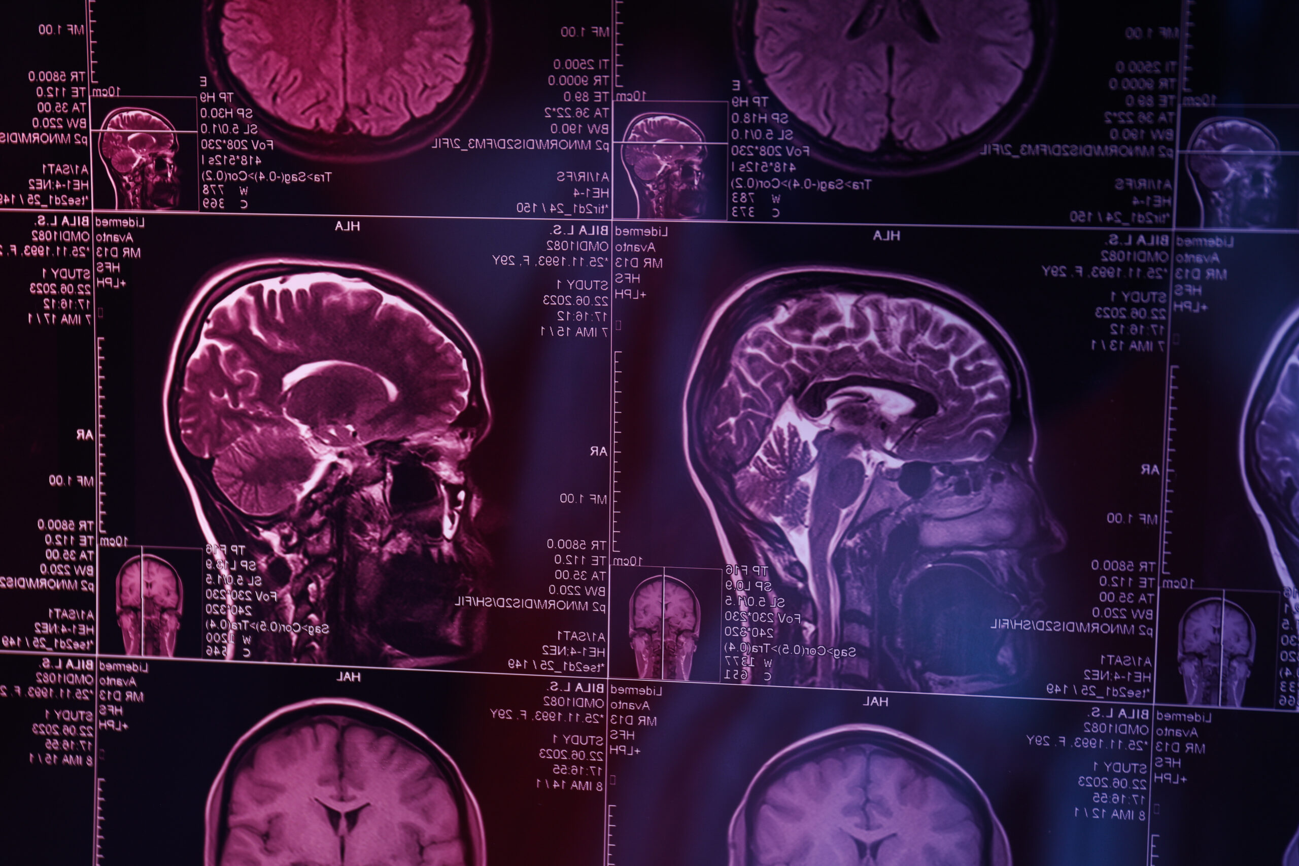 MRI or magnetic resonance imaging of the head and brain. Close u
